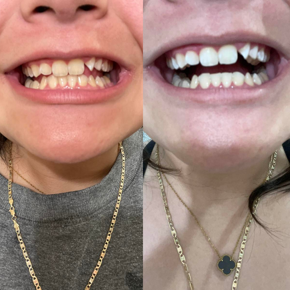 Strisce Sbiancanti Naturali Elovya – All’Olio di Cocco, Senza Dolore, Risultati in 7 Giorni