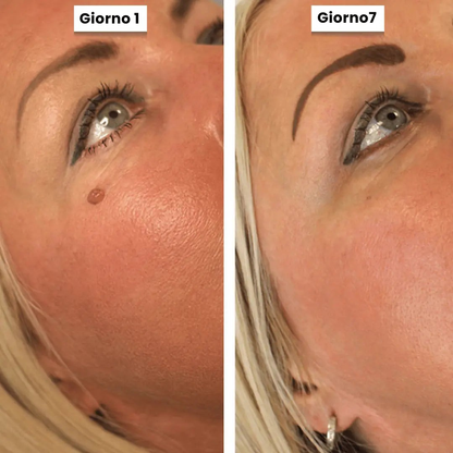 DermaSkin Pro - Addio ai porri della pelle