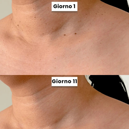 DermaSkin Pro - Addio ai porri della pelle