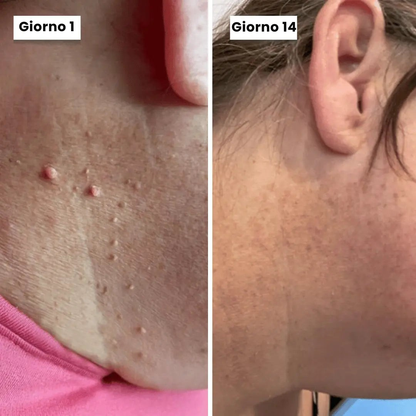 DermaSkin Pro - Addio ai porri della pelle
