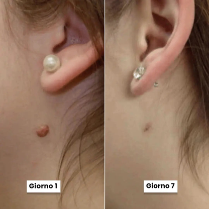 DermaSkin Pro - Addio ai porri della pelle