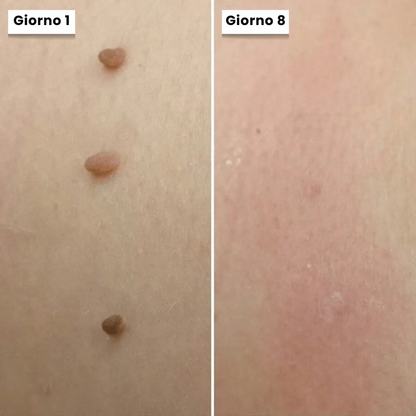 DermaSkin Pro - Addio ai porri della pelle