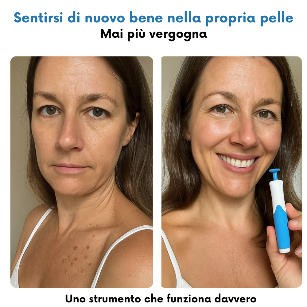 Set completo ALCURA™ - Mai più appendici cutanee
