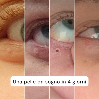 Set completo ALCURA™ - Mai più appendici cutanee