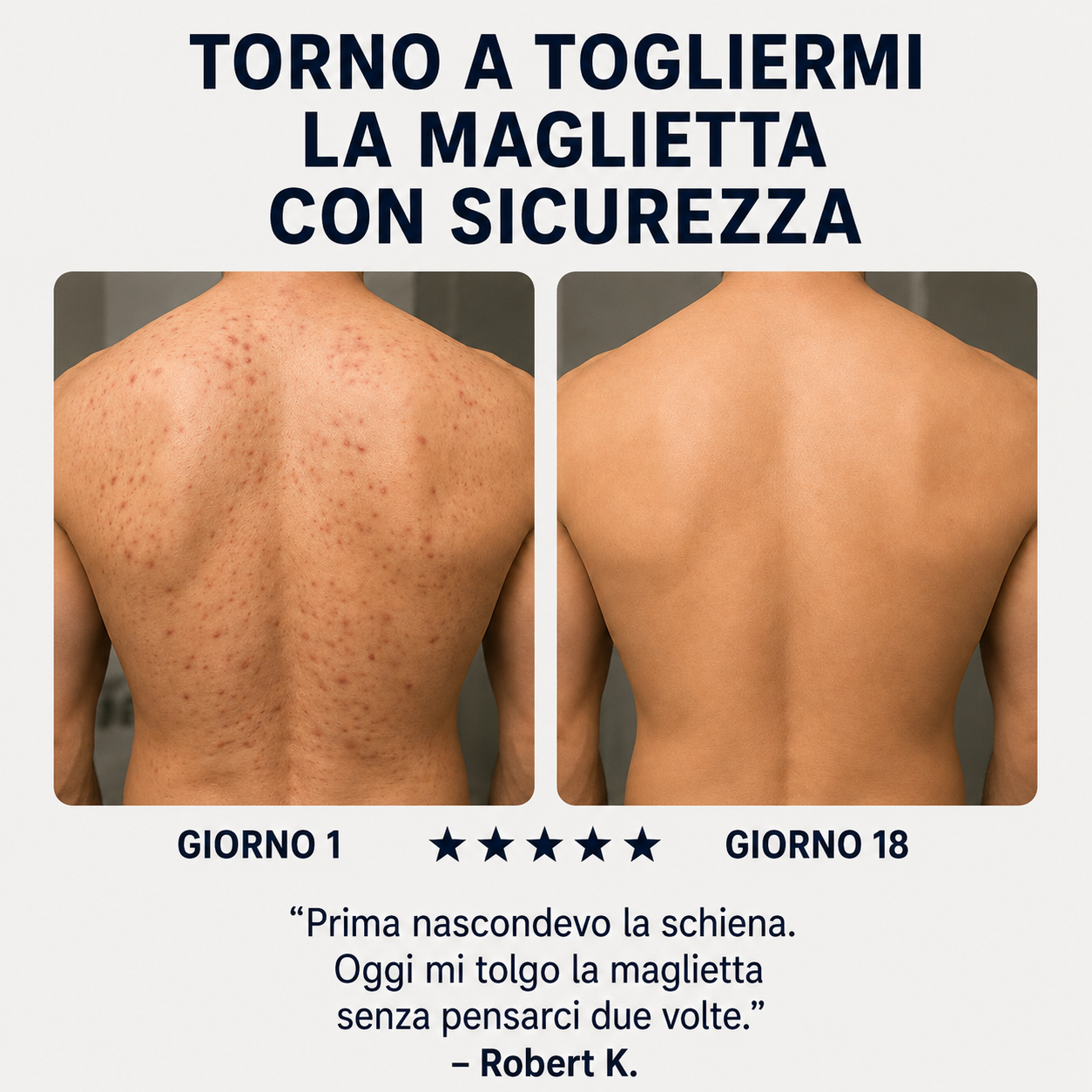 Sapone Zanari per la schiena contro l’acne