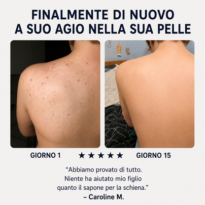 Sapone Zanari per la schiena contro l’acne