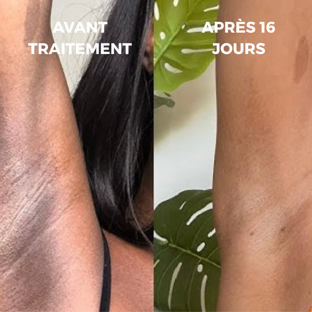 CURVEA | Triple Acide | Peau Lisse et Confiance retrouvée