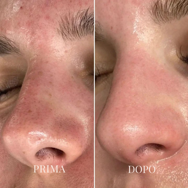 Aspiratore viso innovativo per la cura della pelle