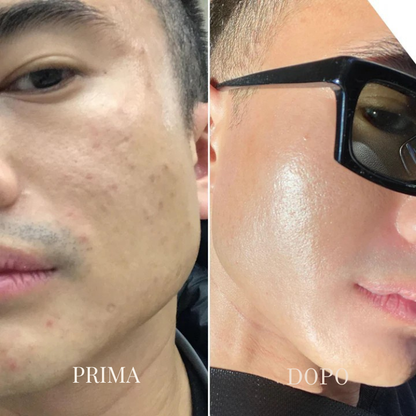 Aspiratore viso innovativo per la cura della pelle