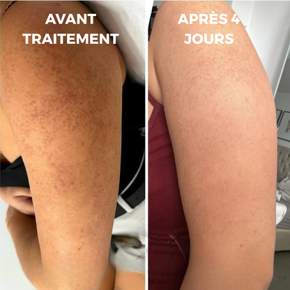 CURVEA | Triple Acide | Peau Lisse et Confiance retrouvée