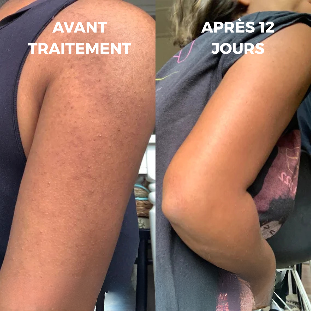 CURVEA | Triple Acide | Peau Lisse et Confiance retrouvée