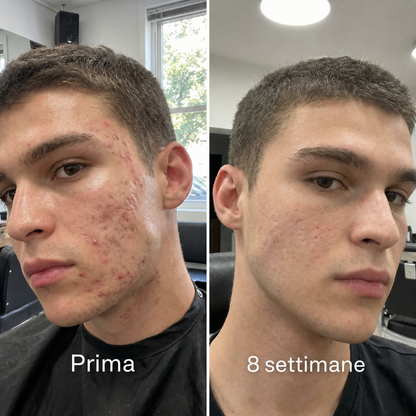 Stick™ per il trattamento clinico delle cicatrici da acne