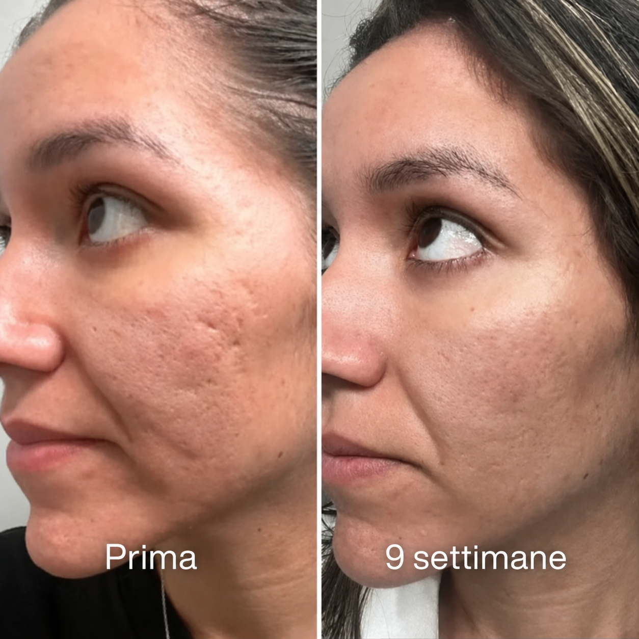 Stick™ per il trattamento clinico delle cicatrici da acne