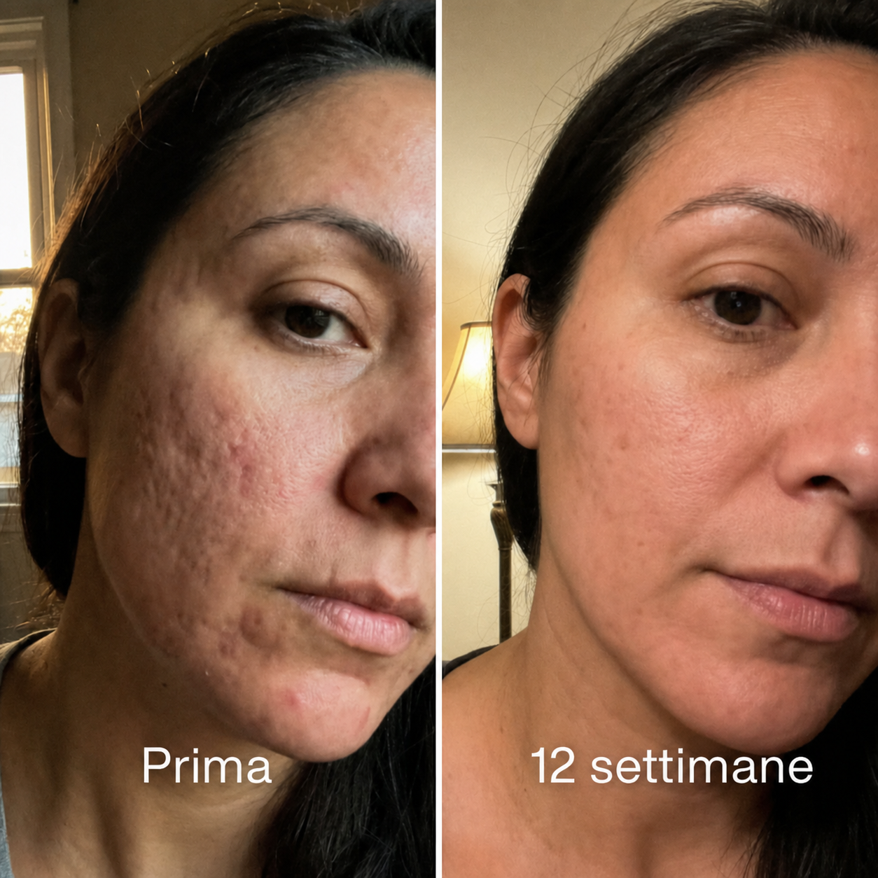 Stick™ per il trattamento clinico delle cicatrici da acne