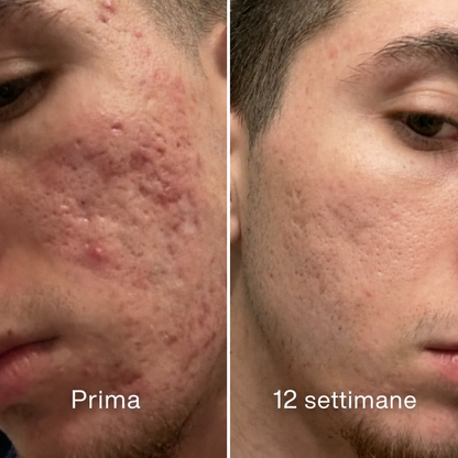 Stick™ per il trattamento clinico delle cicatrici da acne