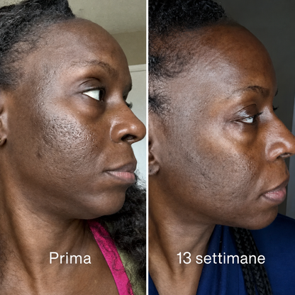 Stick™ per il trattamento clinico delle cicatrici da acne