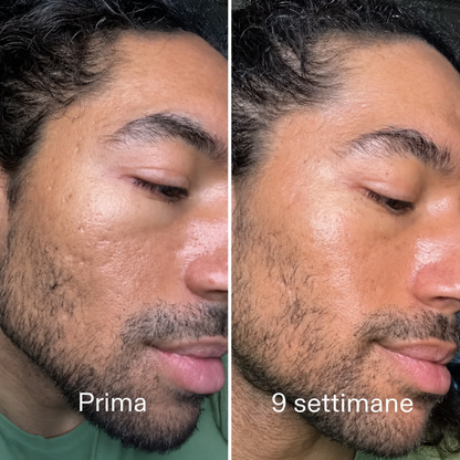Stick™ per il trattamento clinico delle cicatrici da acne