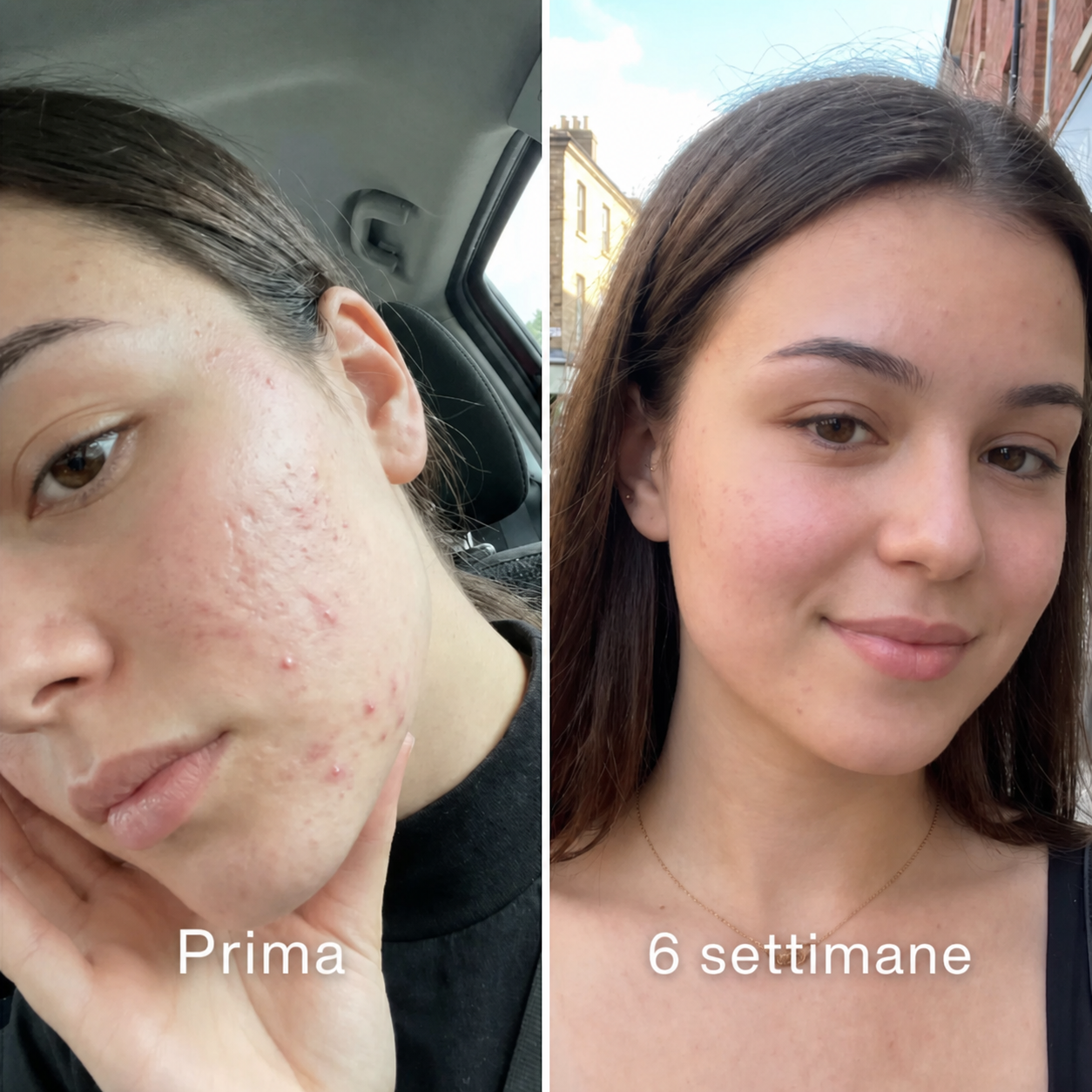 Stick™ per il trattamento clinico delle cicatrici da acne