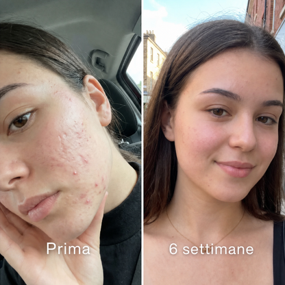 Stick™ per il trattamento clinico delle cicatrici da acne