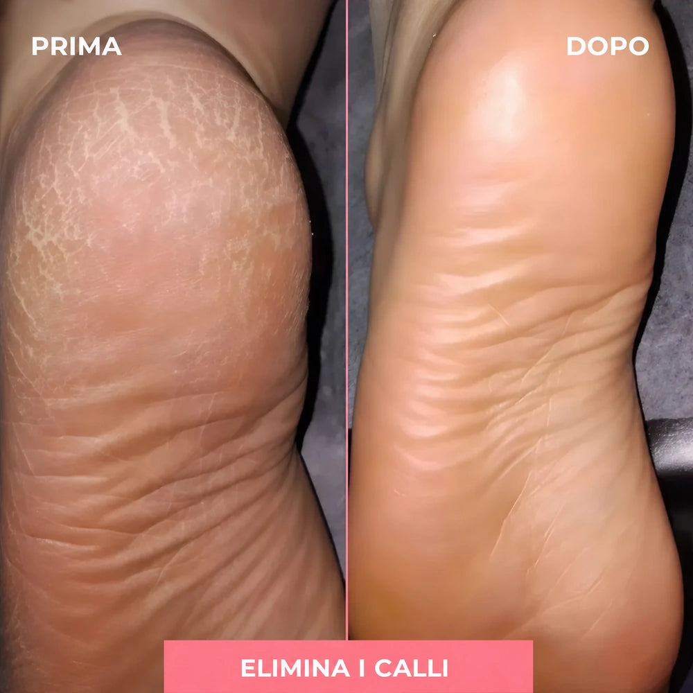 Levigatore elettrico per calli – piedi morbidi a casa
