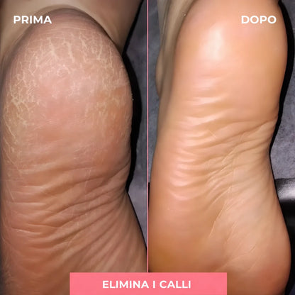 Levigatore elettrico per calli – piedi morbidi a casa