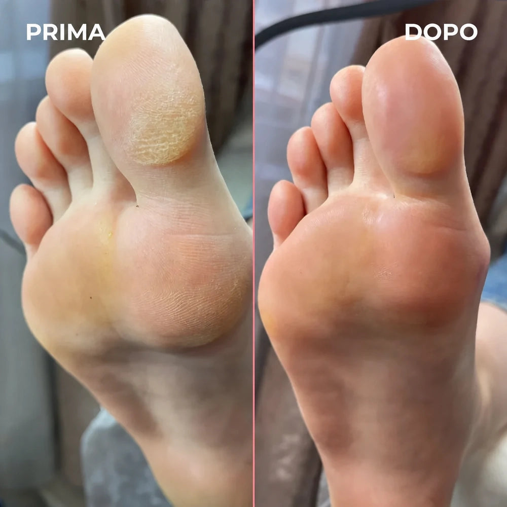 Levigatore elettrico per calli – piedi morbidi a casa