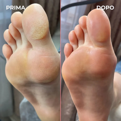 Levigatore elettrico per calli – piedi morbidi a casa