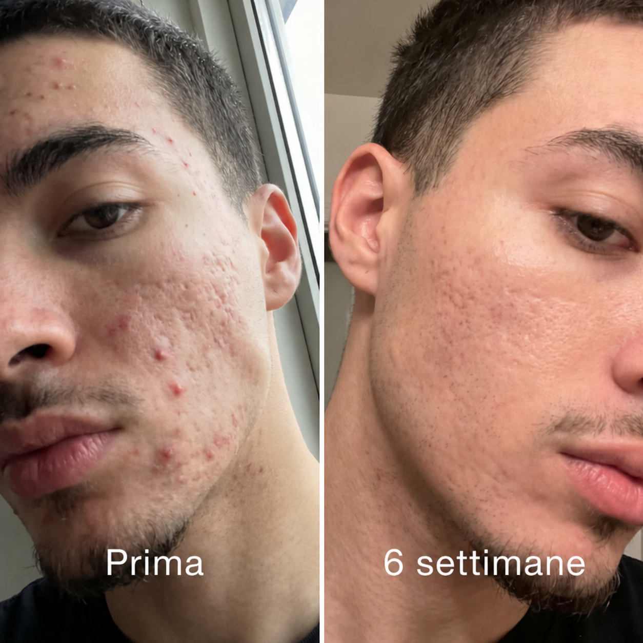 Stick™ per il trattamento clinico delle cicatrici da acne