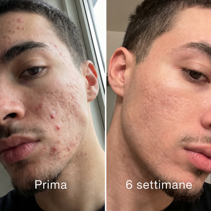 Stick™ per il trattamento clinico delle cicatrici da acne