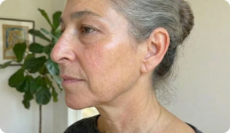 Un effetto lifting naturale, senza aghi